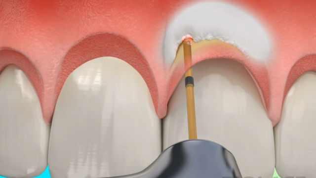 https://laser-dental.ro/wp-content/uploads/2023/10/perio-thumbnail-640x360.png